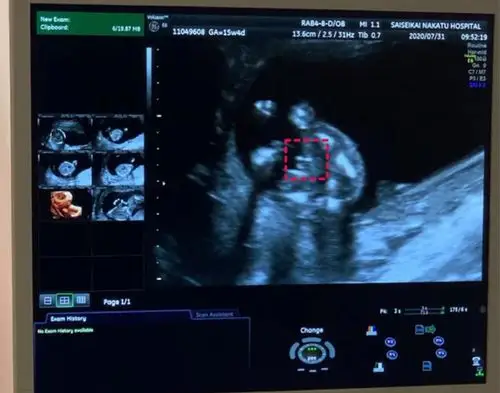 12周nt单子男宝三个亮点图据说这时候看更准哦